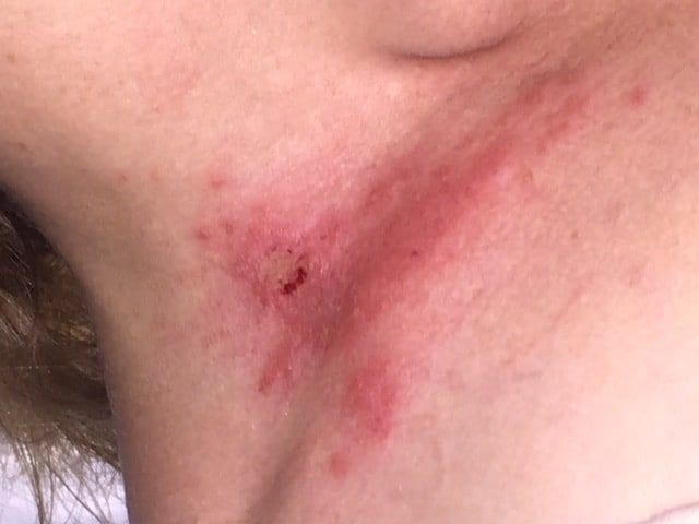 Insect bite